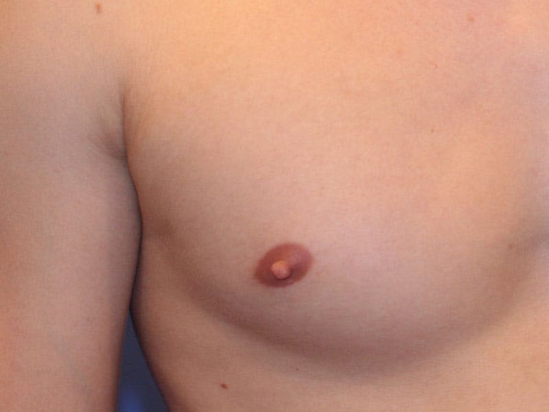 Nipple Surgery Before & After Gallery - Patient 367599 - Image 1