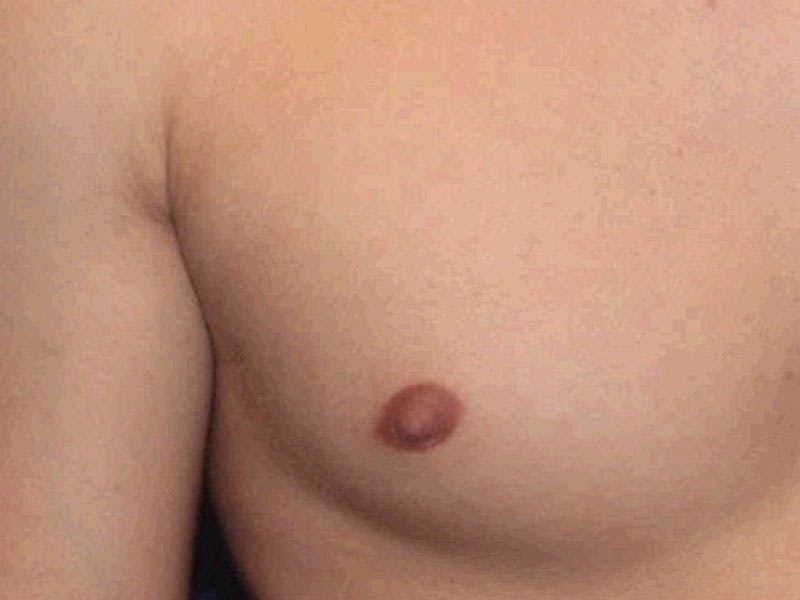 Nipple Surgery Before & After Gallery - Patient 367599 - Image 2