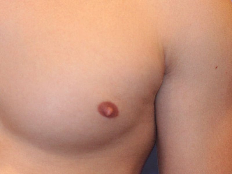 Nipple Surgery Before & After Gallery - Patient 367599 - Image 3