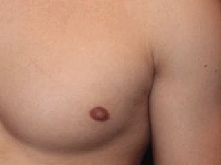 Nipple Surgery Before & After Gallery - Patient 367599 - Image 4