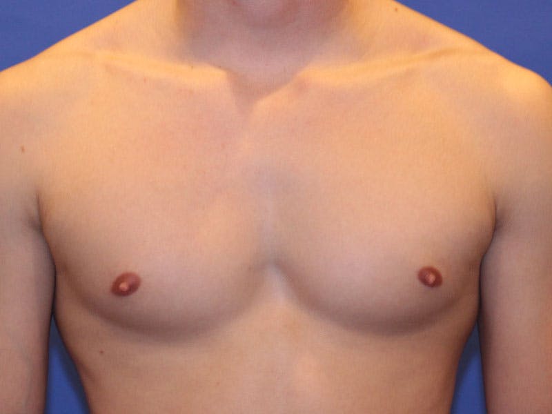Nipple Surgery Before & After Gallery - Patient 367599 - Image 5