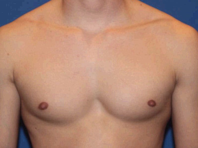 Nipple Surgery Before & After Gallery - Patient 367599 - Image 6