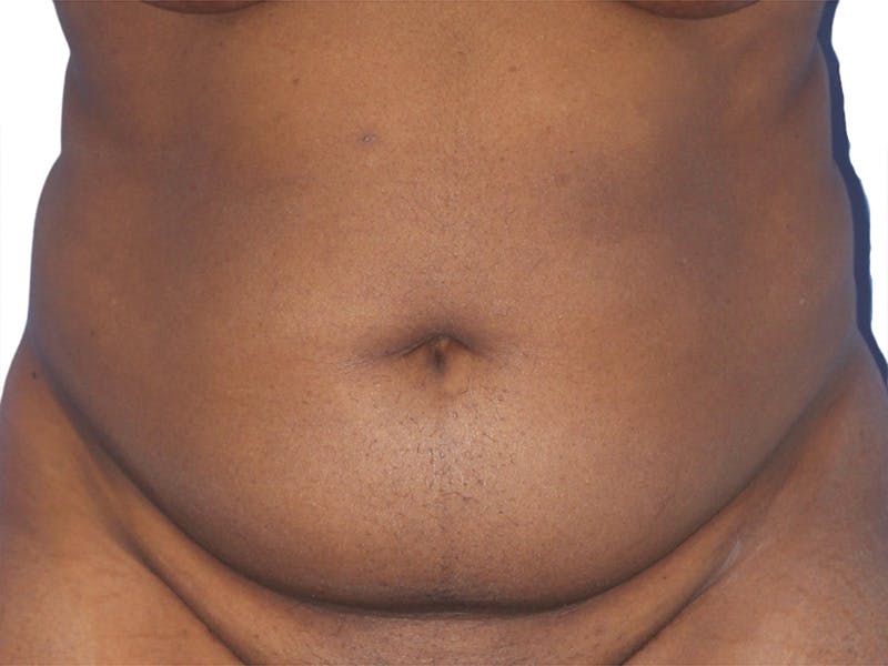 Liposuction Before & After Gallery - Patient 291591 - Image 1