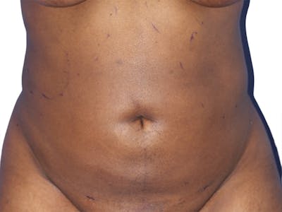 Liposuction Before & After Gallery - Patient 291591 - Image 2