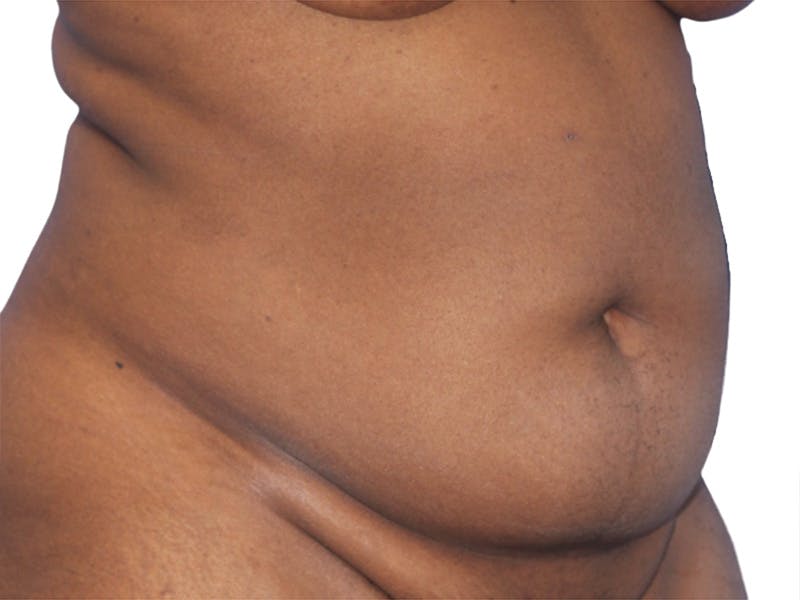 Liposuction Before & After Gallery - Patient 291591 - Image 3