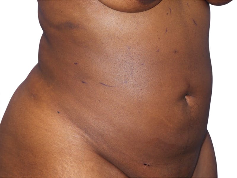 Liposuction Before & After Gallery - Patient 291591 - Image 4