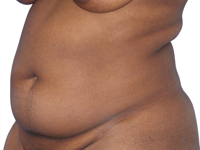 Liposuction Before & After Gallery - Patient 291591 - Image 5