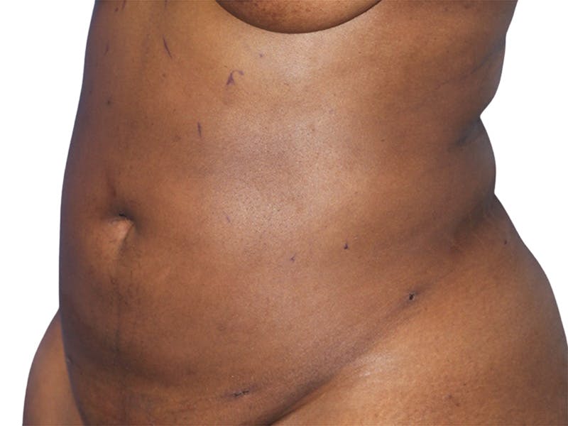 Liposuction Before & After Gallery - Patient 291591 - Image 6