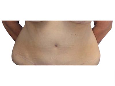 Liposuction Before & After Gallery - Patient 340423 - Image 1