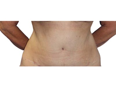 Liposuction Before & After Gallery - Patient 340423 - Image 2