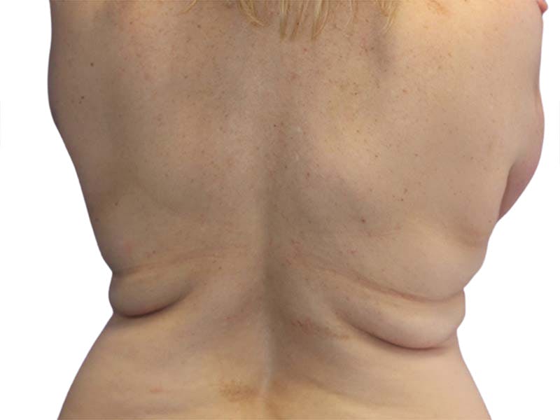 Liposuction Before & After Gallery - Patient 340423 - Image 3