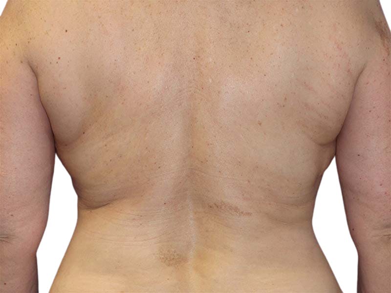 Liposuction Before & After Gallery - Patient 340423 - Image 4