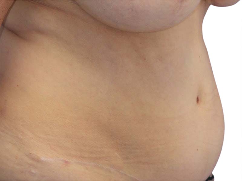 Liposuction Before & After Gallery - Patient 340423 - Image 5