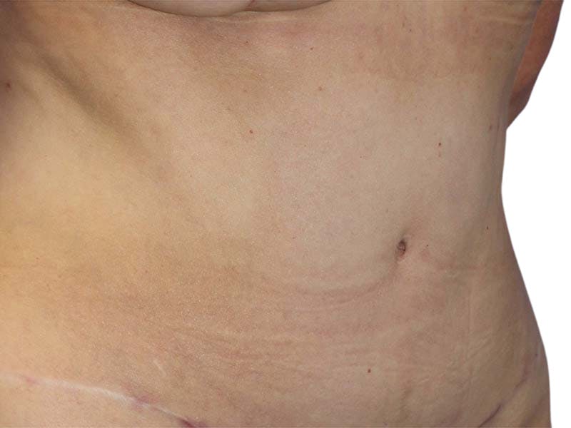 Liposuction Before & After Gallery - Patient 340423 - Image 6