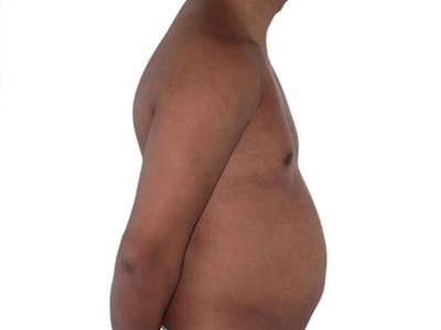 Liposuction Before & After Gallery - Patient 245921 - Image 1