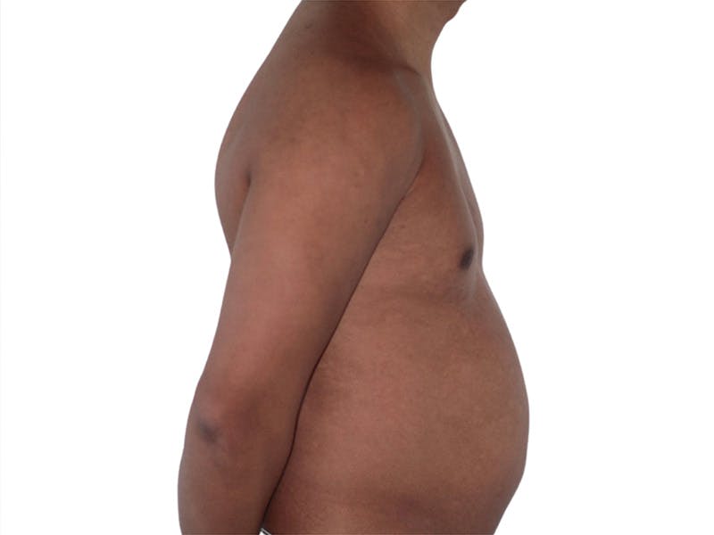 Liposuction Before & After Gallery - Patient 245921 - Image 1
