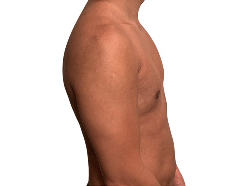 Liposuction Before & After Gallery - Patient 245921 - Image 2