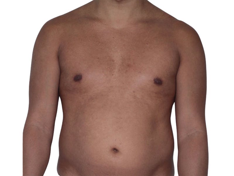 Liposuction Before & After Gallery - Patient 245921 - Image 3