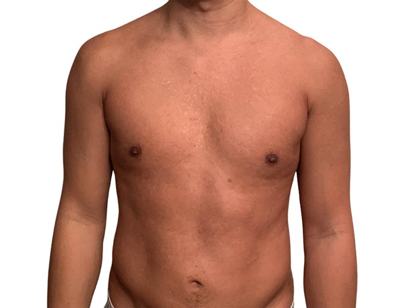 Liposuction Before & After Gallery - Patient 245921 - Image 4