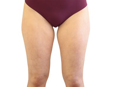 Liposuction Before & After Gallery - Patient 362995 - Image 1