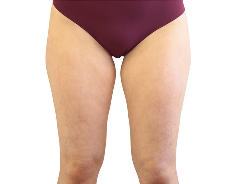 Liposuction Before & After Gallery - Patient 362995 - Image 1