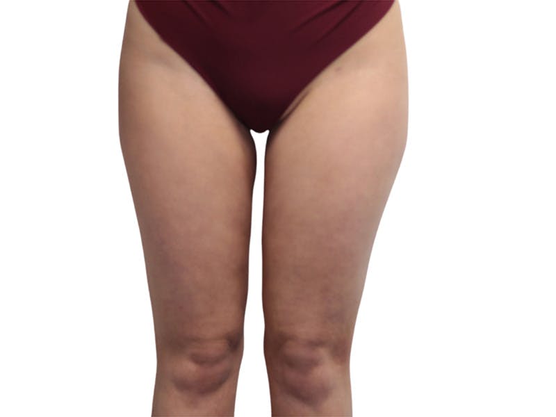 Liposuction Before & After Gallery - Patient 362995 - Image 2