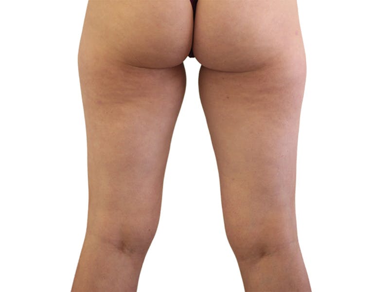Liposuction Before & After Gallery - Patient 362995 - Image 3