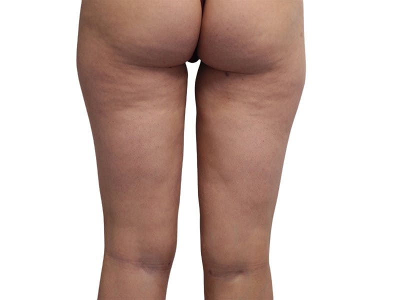 Liposuction Before & After Gallery - Patient 362995 - Image 4