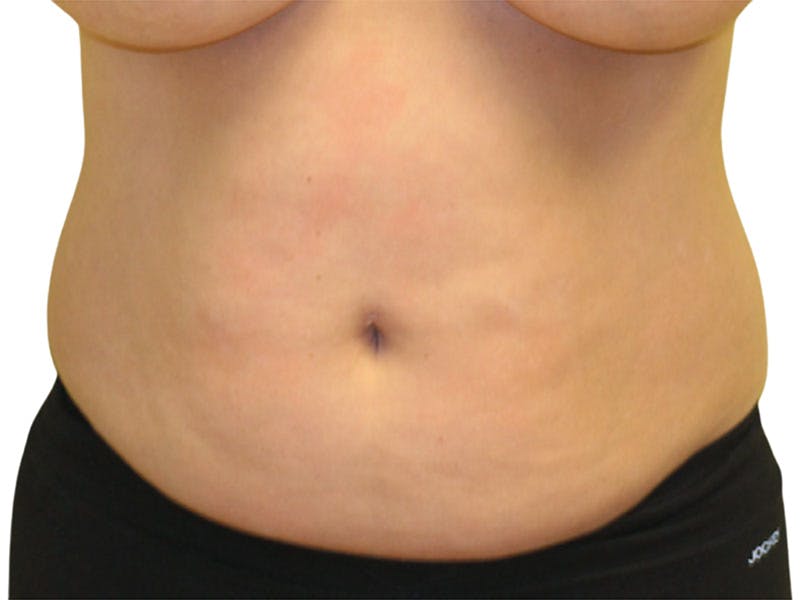 Liposuction Before & After Gallery - Patient 399741 - Image 1