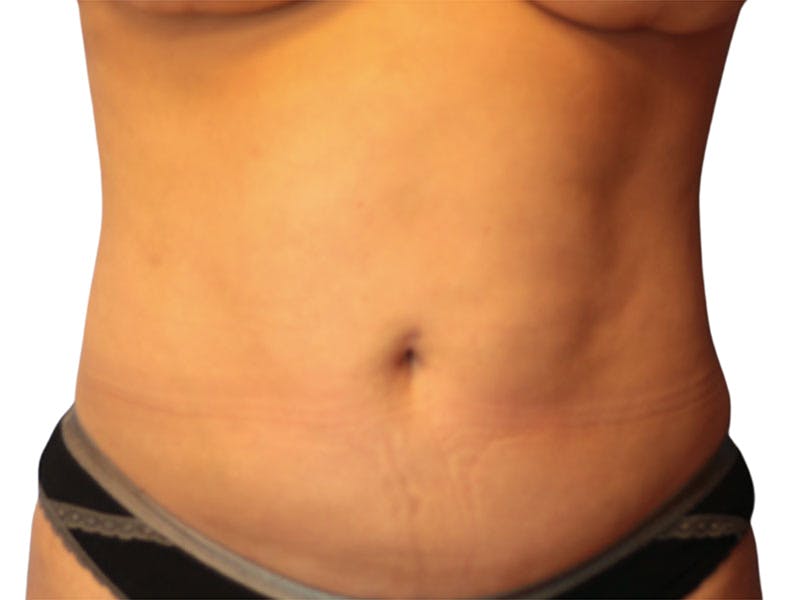 Liposuction Before & After Gallery - Patient 399741 - Image 2