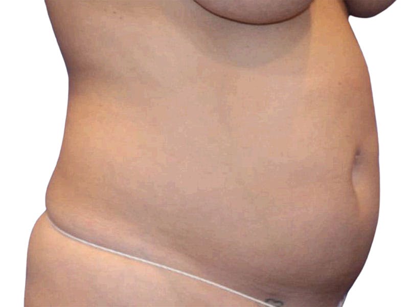 Liposuction Before & After Gallery - Patient 399741 - Image 3