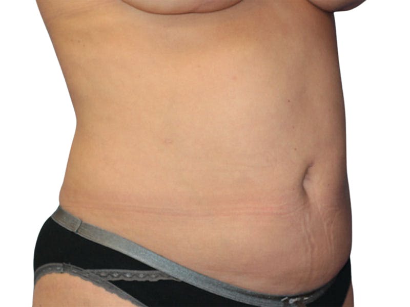 Liposuction Before & After Gallery - Patient 399741 - Image 4