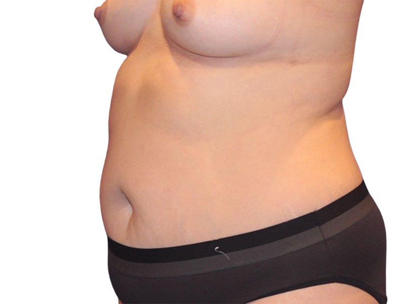 Liposuction Before & After Gallery - Patient 347456 - Image 3