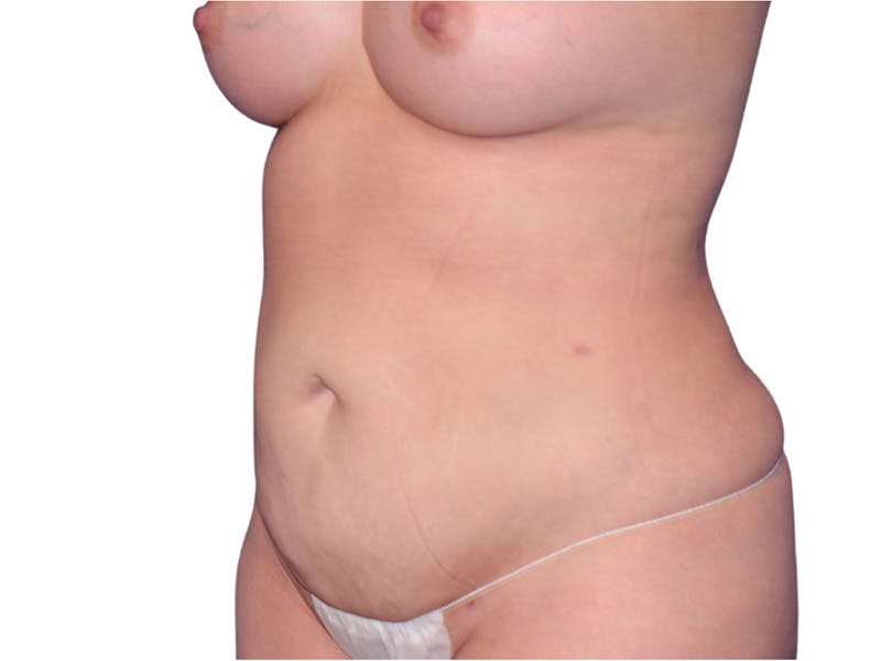 Liposuction Before & After Gallery - Patient 347456 - Image 4