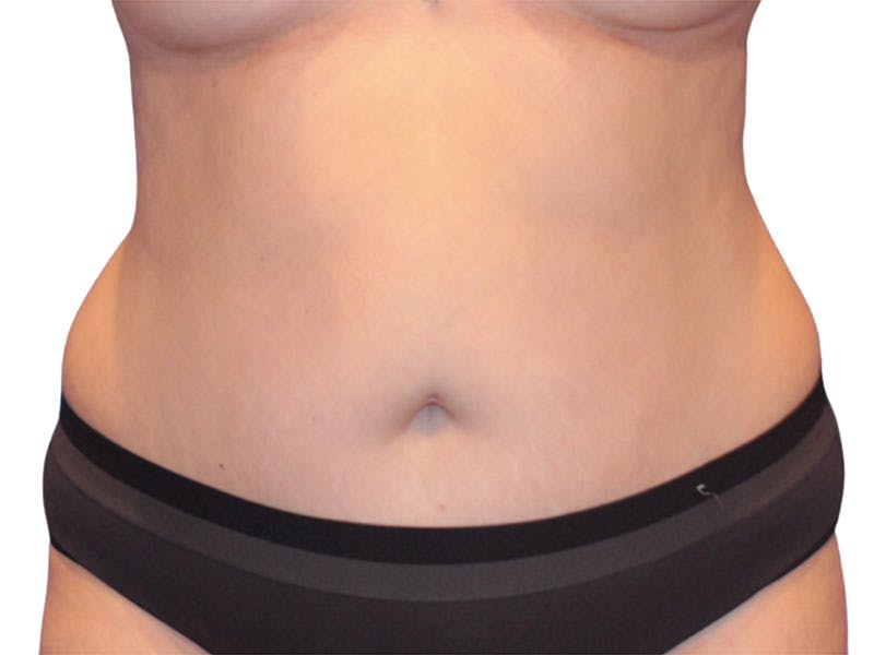 Liposuction Before & After Gallery - Patient 347456 - Image 5