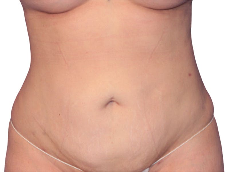 Liposuction Before & After Gallery - Patient 347456 - Image 6