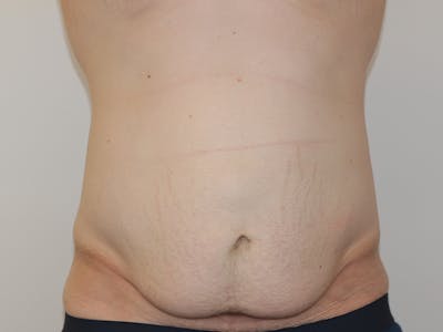 Tummy Tuck Before & After Gallery - Patient 365381 - Image 1