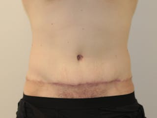 Tummy Tuck Before & After Gallery - Patient 365381 - Image 2