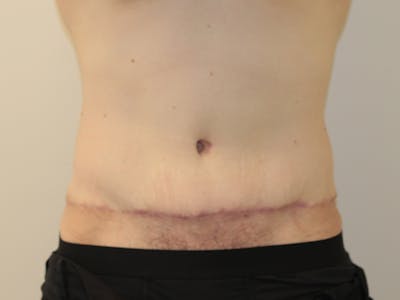 Tummy Tuck Before & After Gallery - Patient 365381 - Image 2