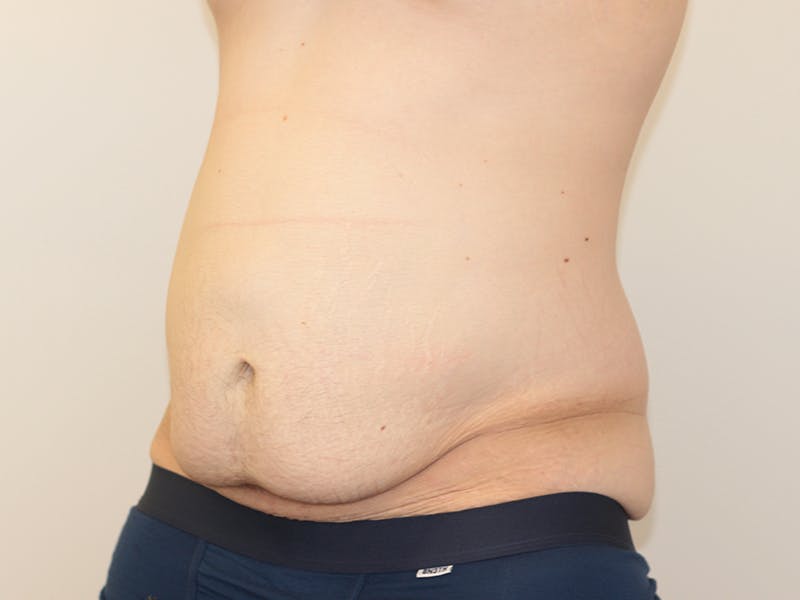 Tummy Tuck Before & After Gallery - Patient 365381 - Image 3