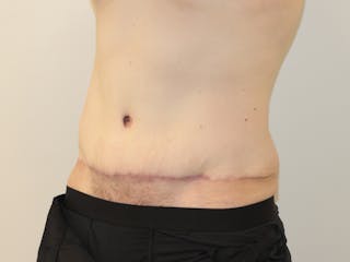 Tummy Tuck Before & After Gallery - Patient 365381 - Image 4