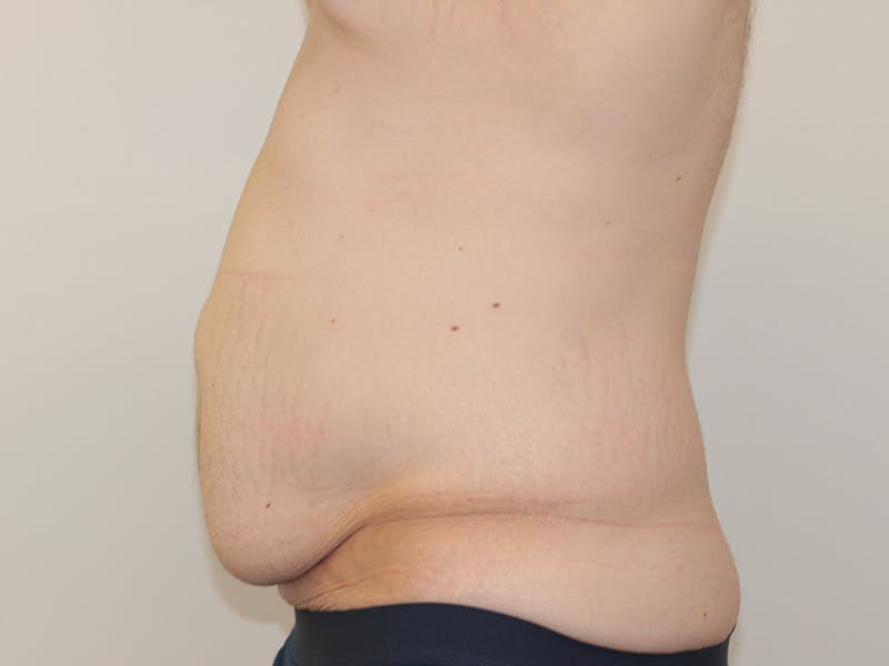 Tummy Tuck Before & After Gallery - Patient 365381 - Image 5