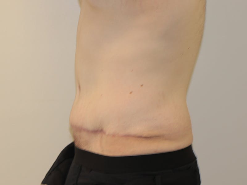 Tummy Tuck Before & After Gallery - Patient 365381 - Image 6