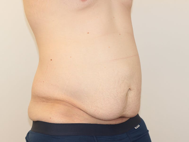 Tummy Tuck Before & After Gallery - Patient 365381 - Image 7