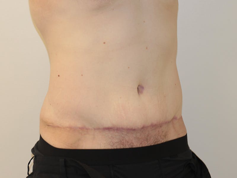 Tummy Tuck Before & After Gallery - Patient 365381 - Image 8