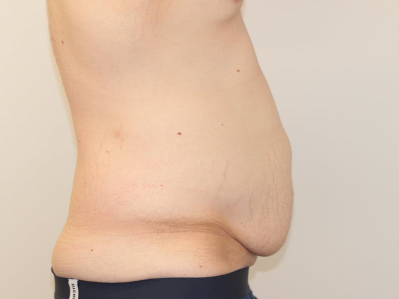 Tummy Tuck Before & After Gallery - Patient 365381 - Image 9