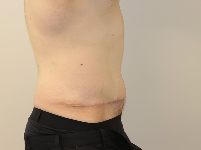 Tummy Tuck Before & After Gallery - Patient 365381 - Image 10
