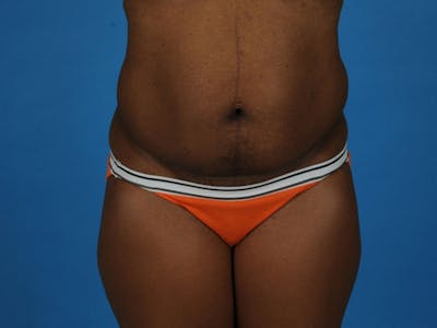 Tummy Tuck Before & After Gallery - Patient 217166 - Image 1