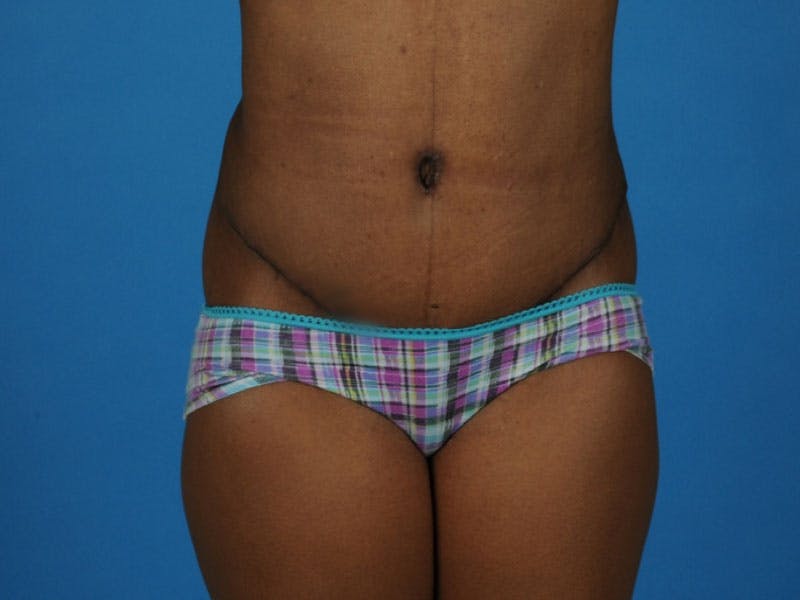 Tummy Tuck Before & After Gallery - Patient 217166 - Image 2