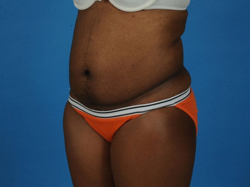 Tummy Tuck Before & After Gallery - Patient 217166 - Image 3